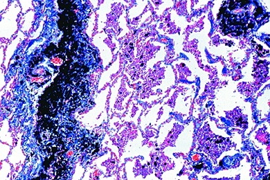 Mikropräparat - Kohlenstaublunge, Anthracosis pulmonum