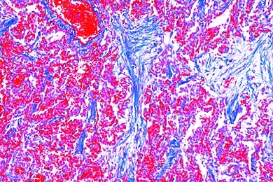 Mikropräparat - Chronische Pneumonie, Pneumonia chronica