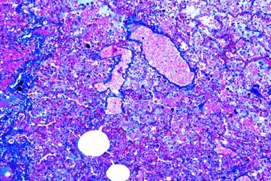 Mikropräparat - Embolische, nicht eitrige Glomerulonephritis