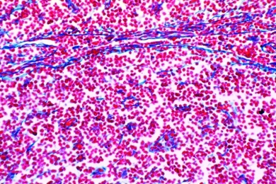 Mikropräparat - Lymphosarkom des Mittelfells, Lymphosarcoma mediastini