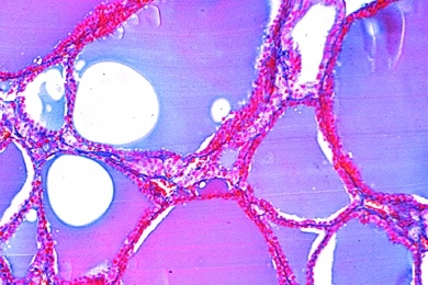 Mikropräparat - Kropf, Struma colloides