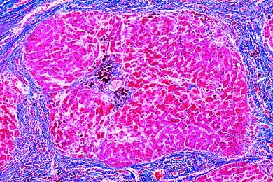 Mikropräparat - Pigmentzirrhose der Leber