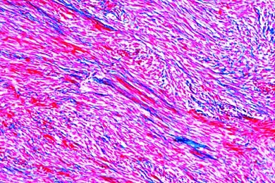 Mikropräparat - Spindelzellensarkom