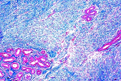 Mikropräparat - Fibroma intracanaliculare mammae, Geschwulst der Mamma