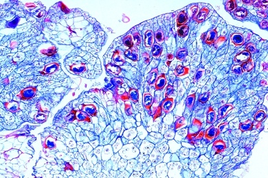 Mikropräparat - Kartoffelkrebs, Synchytrium endobioticum, erkrankte Knolle