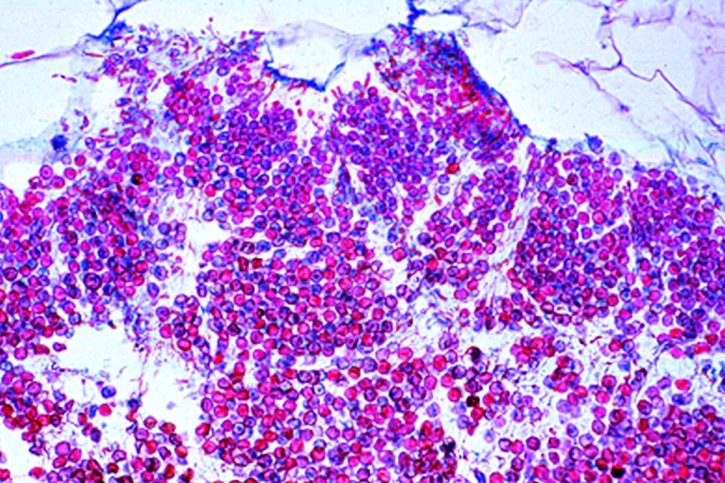 Mikropräparat - Ustilago zeae, Beulenbrand vom Mais, Gewebewucherung mit Sporenlagern, quer