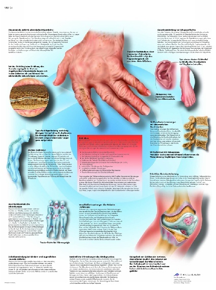 Anatomische Lehrtafel, Rheumatische Erkrankungen