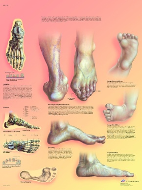 Anatomische Lehrtafel, Fehlstellungen der Füße